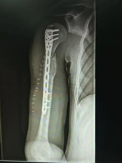 动脉瘤样骨囊肿_动脉瘤性骨囊肿_疾病介绍_手术_治疗方法_介绍_治疗