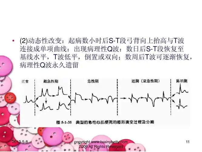起病数小 时后s-t段弓背向上抬高与t波 连接成单项曲线:出现病理性q波