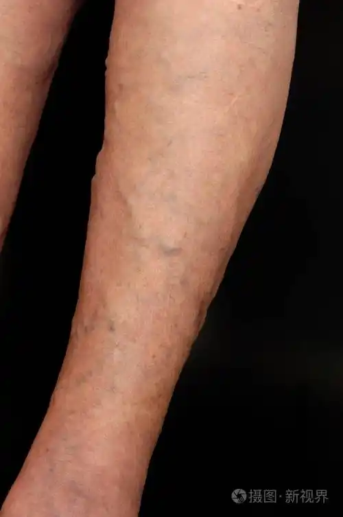 一个女人的腿静脉曲张