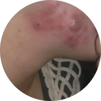 3.痤疮的变异型,如暴发性痤疮和聚合性痤疮,应当系统使用抗生素.