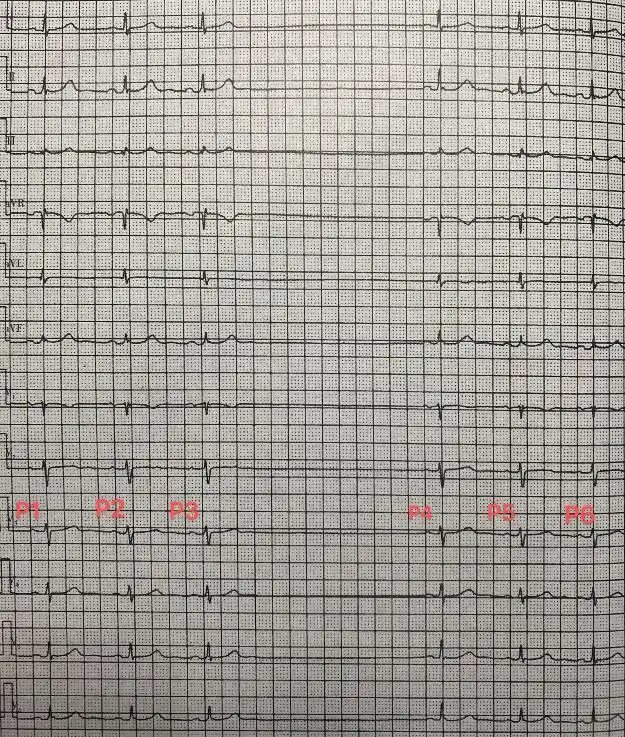 高度窦房传导阻滞心电图怎么看