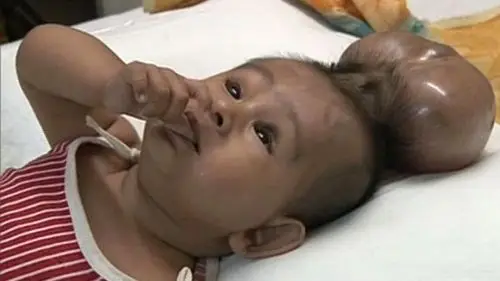 先天畸形印度男婴天生两个头