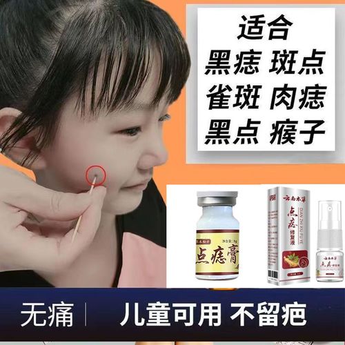 【正品点痣膏】点痣无痕药水套装脸部无痛祛黑痣肉痣痦子斑点神器