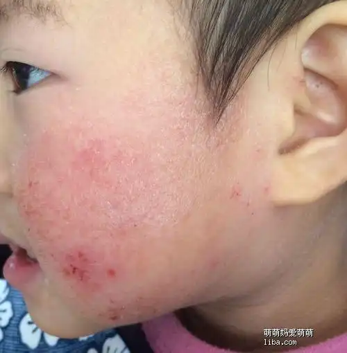 从今天开始记录宝宝的湿疹之路!有类似症状宝宝的怎么治好的能好吗?
