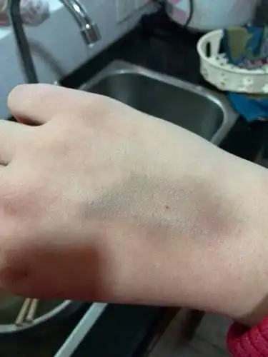 手背和胳膊在被针头扎了后(打点滴,抽血后),变青变肿是什么原因?