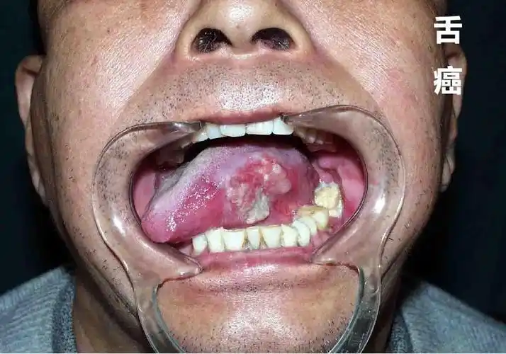 口腔癌可发生任何年龄,以40-60岁为发病高峰,男性发病率明显高于女性