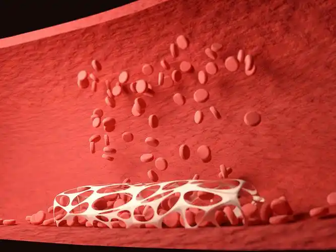 糖尿病患者的血管病变与血液高凝状态密切相关.