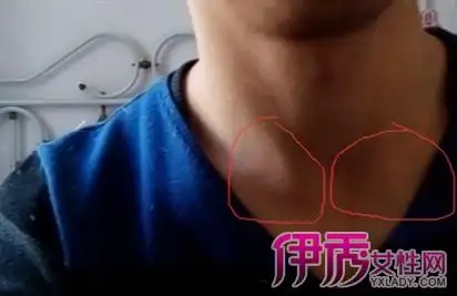 【图】锁骨淋巴结肿大图片欣赏 6大分类为你详细道来