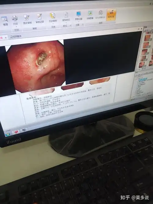 胃溃疡做胃镜让进一步活检麻烦问下个各位很严重吗