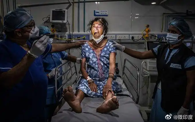 印度超3万人感染毛霉菌病#据印度新德. 来自微印度 - 微博