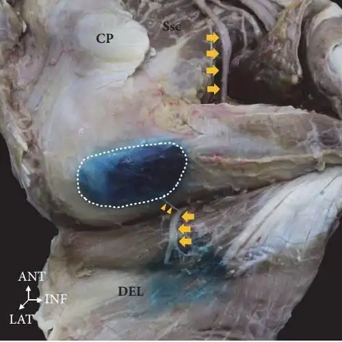 肩关节外侧疼痛的原因之一:三角肌下滑囊炎. - 好大夫在线