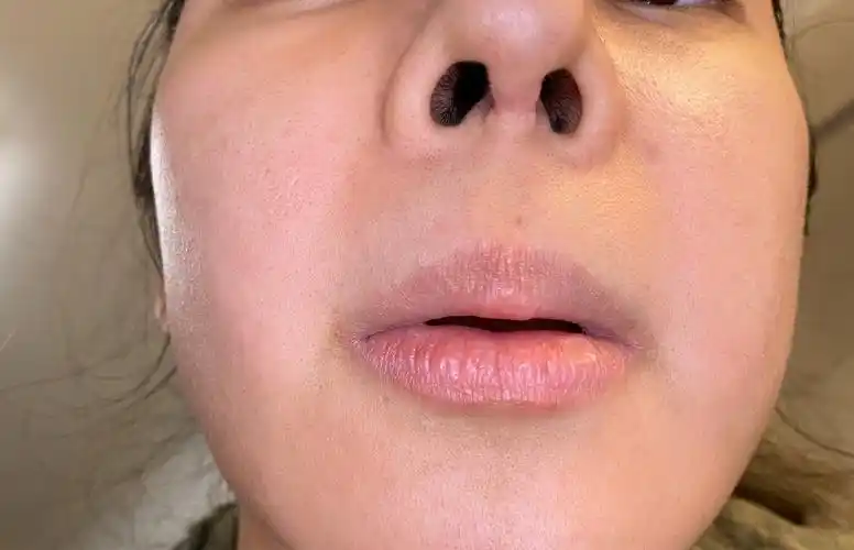 请问鼻小柱这样的疤痕还能修复吗