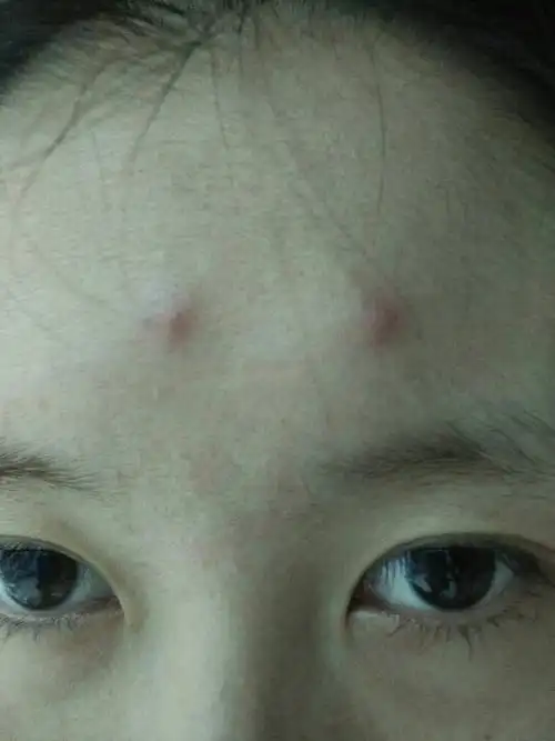 额头上最近长了两个大胞,起初特别疼,现在用手压才会疼,很硬,有三天了