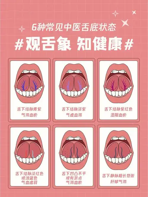 ①舌下络脉青紫——气滞血瘀②舌下络脉淡紫——气虚血滞③舌下络脉