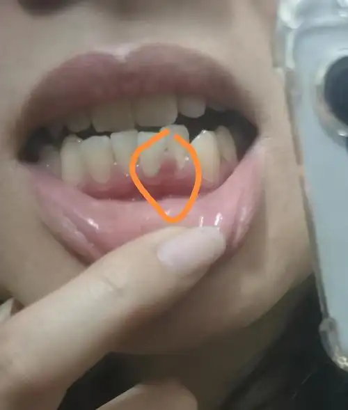 有一个牙龈肿了怎么回事
