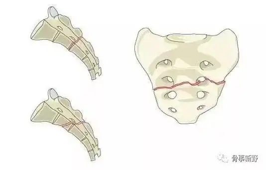 骶骨骨折的解剖概要及分型
