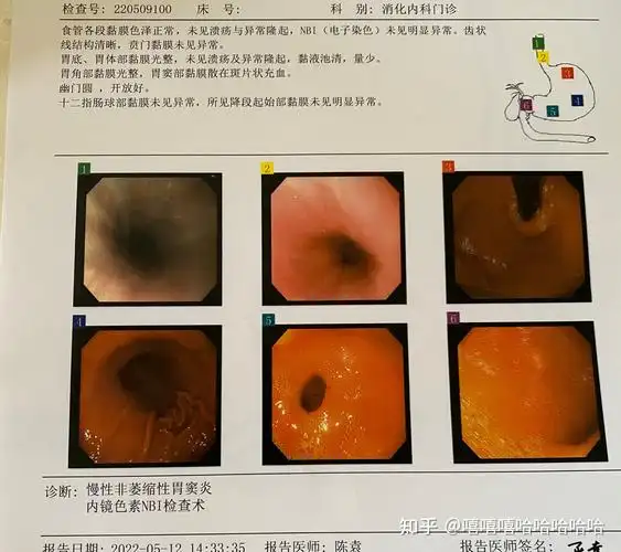 第一次无痛肠胃镜过程不舒服一定要早点去检查