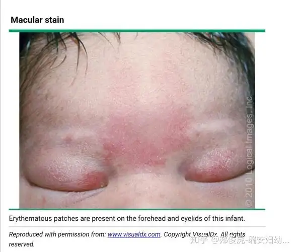 单纯痣新生儿红斑