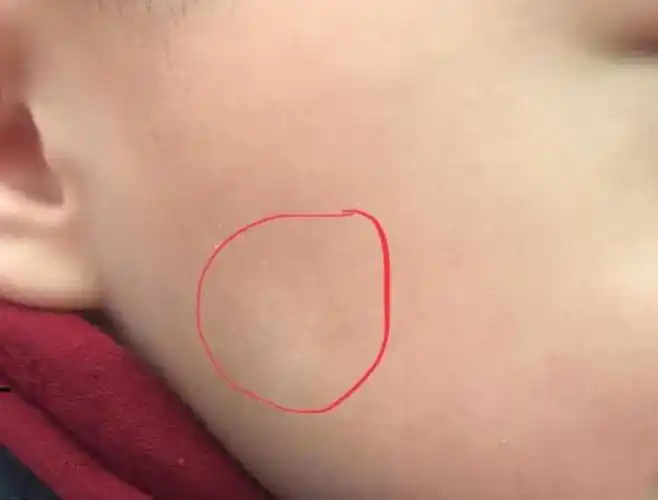 孩子脸上的白块是虫斑吗会发展为白癜风吗