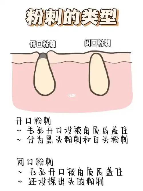 9890 什么是开口闭口粉刺71