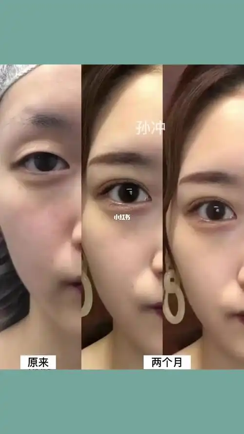 眼窝凹陷 提肌无力_肌无力_双眼皮_美妆_医美整形