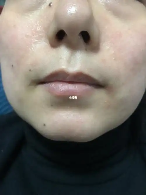 激素依赖性皮炎2021116