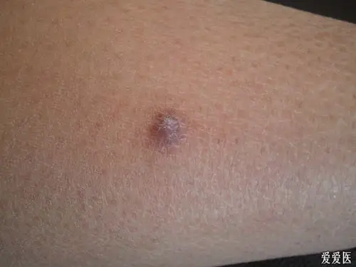 猜图病例10答案皮肤纤维瘤29人回答准确均加分