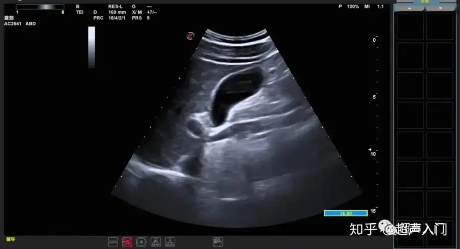 超声入门:急,慢性胆囊炎超声如何诊断?