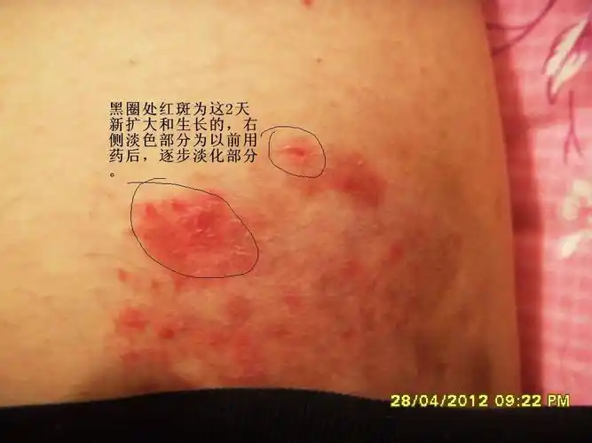抹的皮肤性病科 皮肤病 接触性皮炎