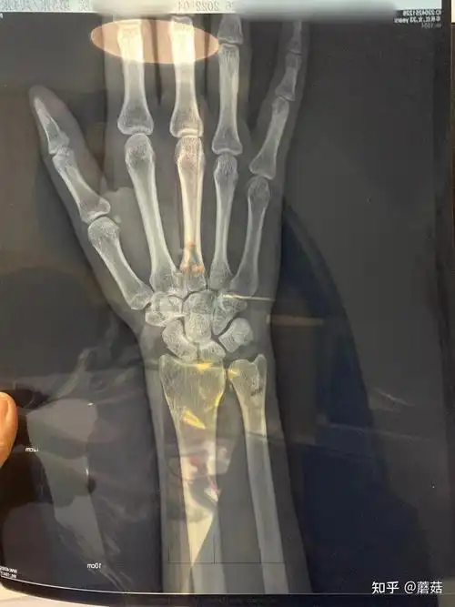 翻出了期间的各种片子,报告,开始研究,结果看到了手腕x光片的报告,尺