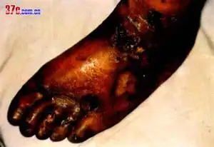 初起患部胀痛编辑4病理疔疮疾患之一.