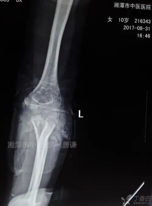 桡骨颈骨折合并鹰嘴骨折的保守治疗 [病例帖]