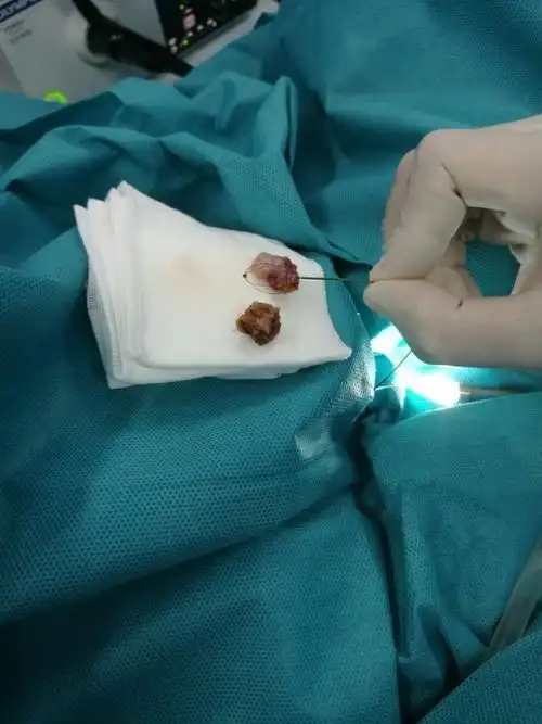 膀胱肿瘤整块剜除技术 - 好大夫在线