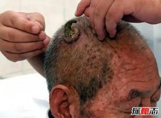 百岁老人头上长犄角之谜预示癌症病变皮肤肿瘤