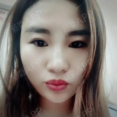 线雕的第三天了,鼻子还是有些肿,触摸鼻子时还是有点_圈子-新氧美容