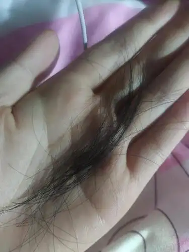 姐妹们,急急急,突然掉了一撮头发怎么办