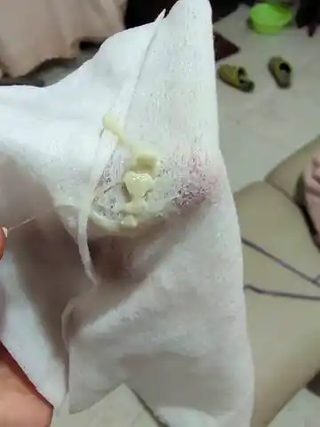 从怀孕到现在都是这样的豆腐渣样白带,现在孕十周 6,感觉好烦啊,现在