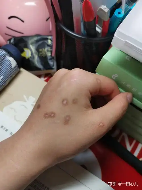 扁平疣冷冻 - 知乎