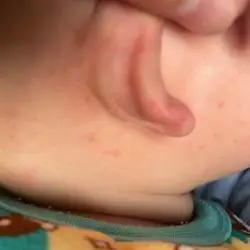 最近三天前刚刚吃了米粉之后就有点这样我觉得会不会过敏了米粉哪位