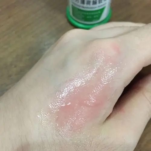 请问图中这样的烫伤会留疤吗?