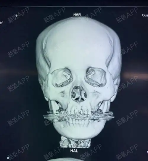 鼻小柱严重偏曲,鼻孔大小不一,ct清晰可见,给予:自体肋骨中隔重建术