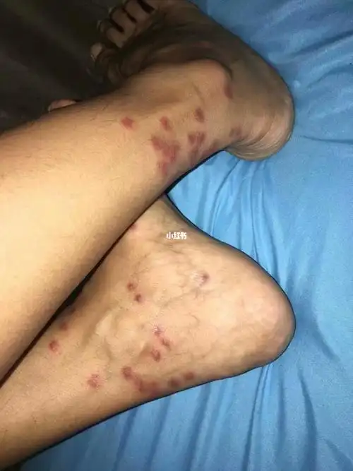 脚脖子不"奇痒难忍"的感觉真好[流泪] 真爱生命远离槟榔虫/蠓虫[流泪]