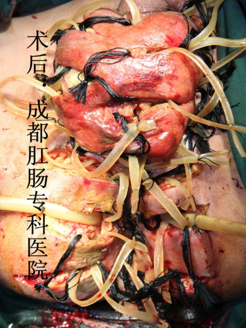 肛门,会阴坏死性筋膜炎-不是所有的肛门疼痛都是肛周脓肿 - 好大夫