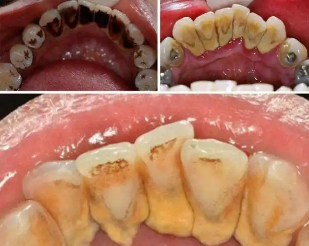 男生烟牙黄牙口臭怎么办这个神器帮你一招解决