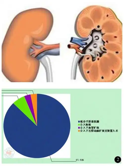 泌尿外科少见的"急事"——急性肾梗死