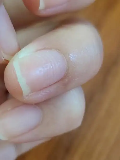 指甲上的凹点到底是啥啊