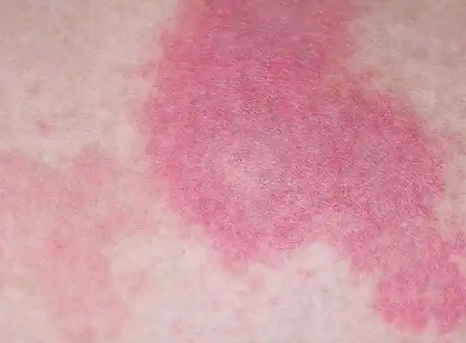 最后,大家不用担心的是,目前系统性红斑狼疮不会传染,因患系统性红斑