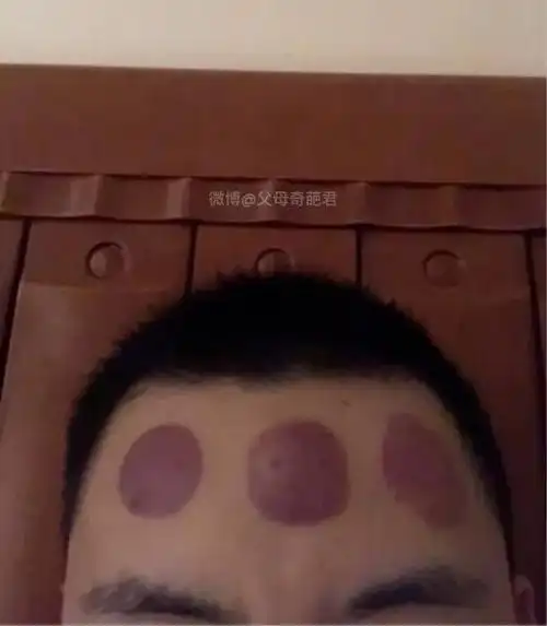 图:一网友额头上长了一个痘痘, 他妈妈认为是有湿气,于是