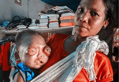 印度2岁童患眼疾,眼珠肿大到快掉出来,样子让人落泪!