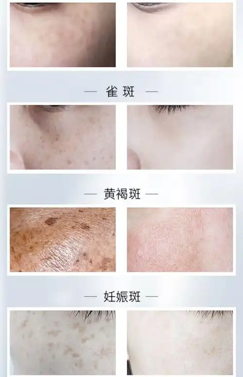 熊果苷美白祛斑霜正品去斑晒雀斑黄褐斑淡斑神器面霜淡化色斑套装